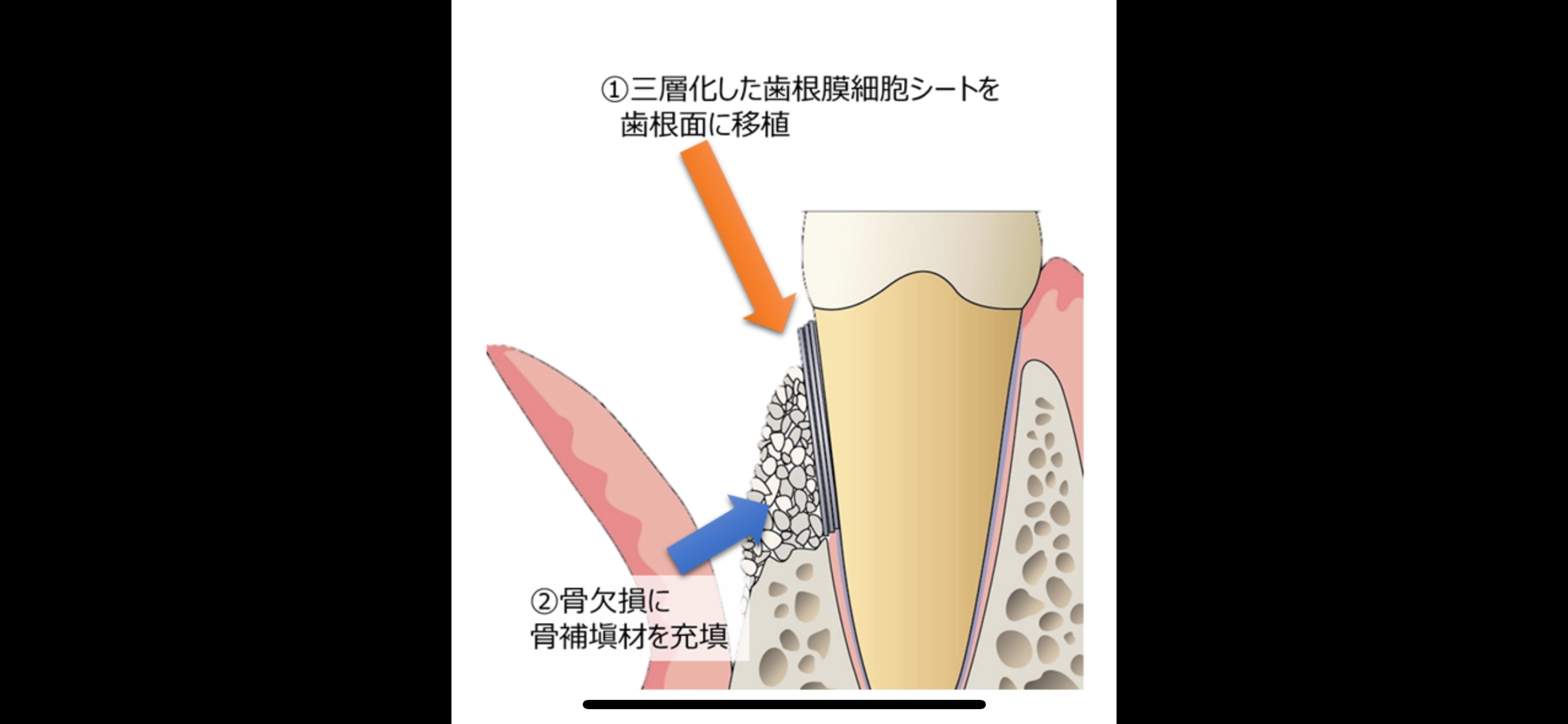 日本歯周病学会@郡山