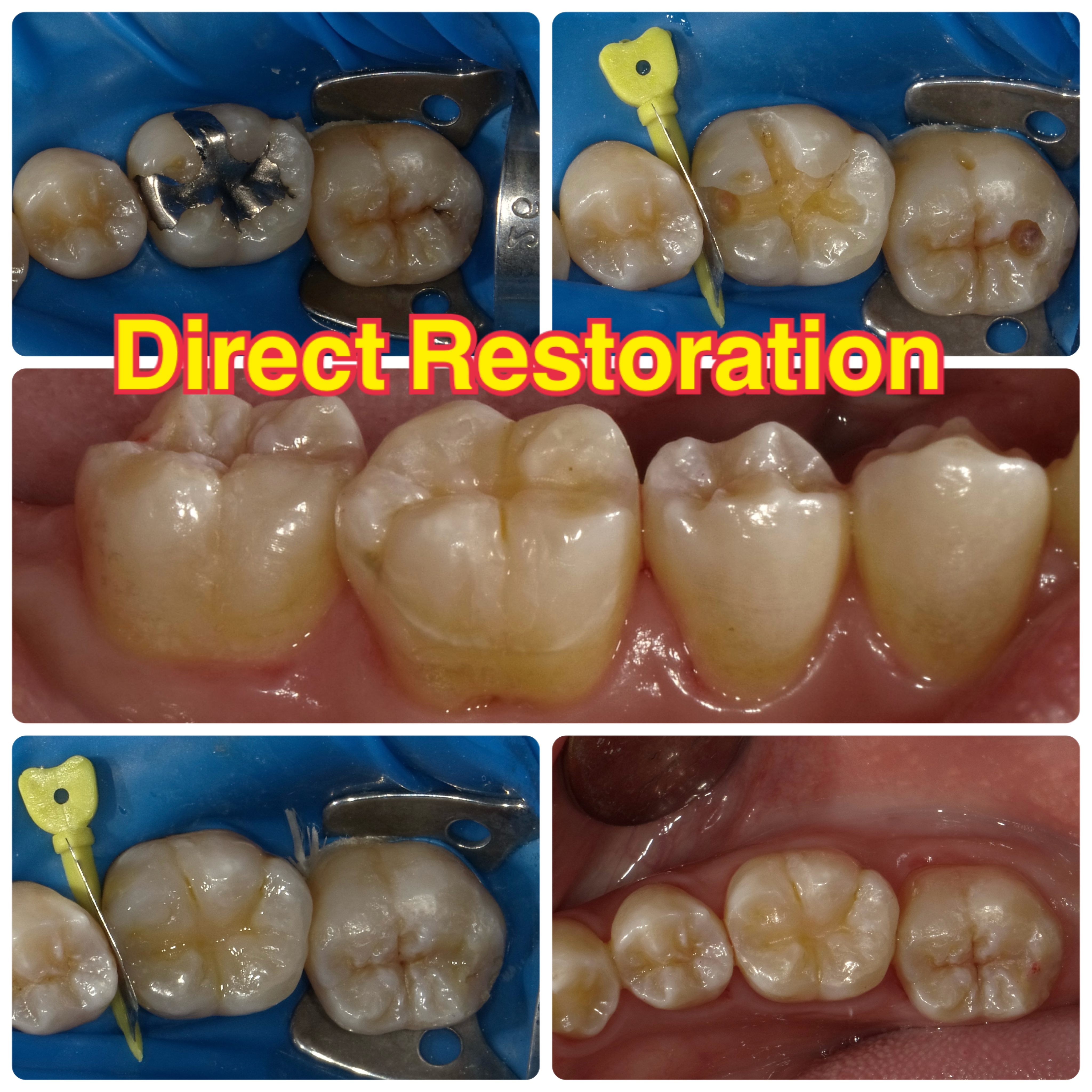 歯の復元