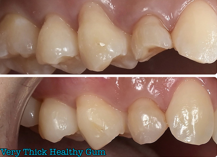 歯茎下がりの主な原因